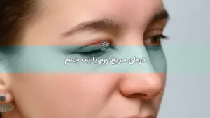 سریع ورم یا پف چشم